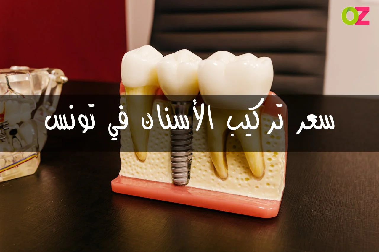 سعر تركيب الأسنان في تونس